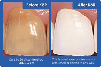 KöR® Whitening