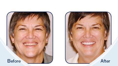 LUMISmile before & after