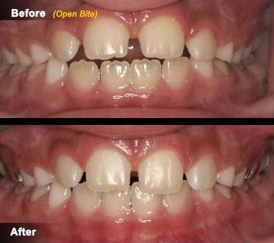 Open Bite and Cross Bite