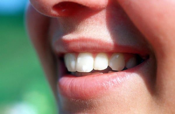 Close up of teeth with white spots on them